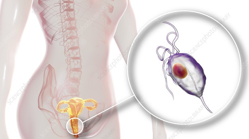 महिला योनी र पुरुषको मूत्रनलीमा हुने संक्रमण ट्राइकोमोनास